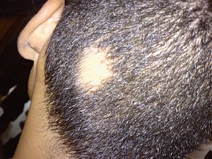 Small Bald Patch On Top Of Head